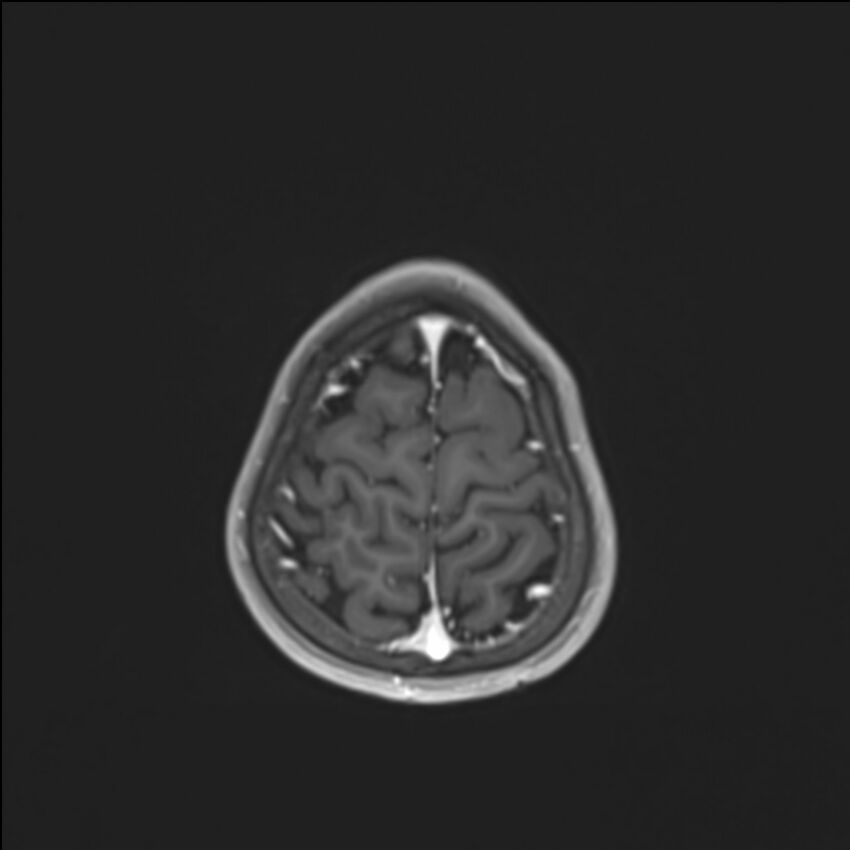 Brainstem glioma (Radiopaedia 70548-80674 Axial T1 C+ 138).jpg
