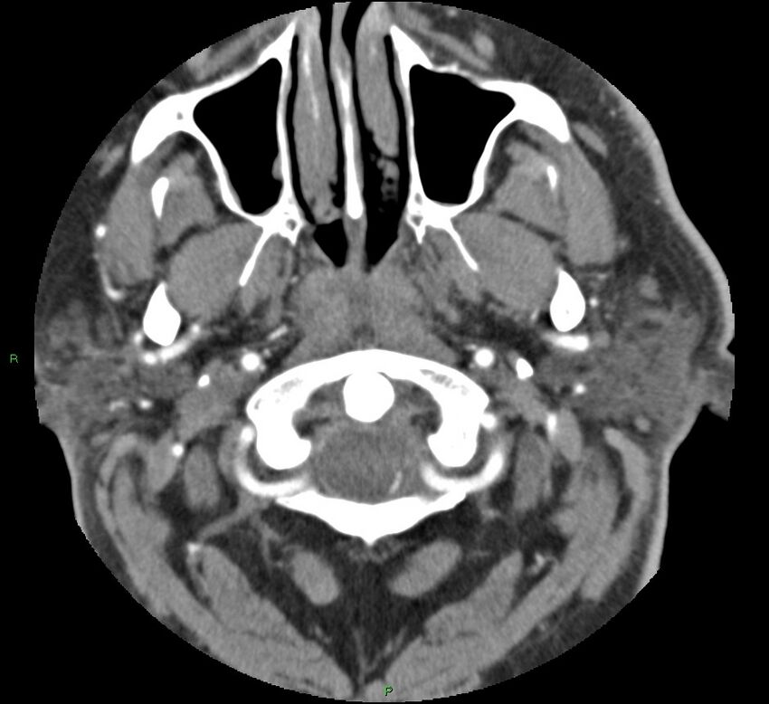 Brainstem hemorrhage (Radiopaedia 58794-66028 D 7).jpg
