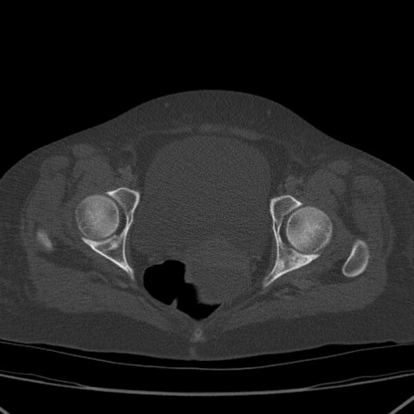 File:Breast cancer metastases - hepatic and skeletal (Radiopaedia 34201-35461 Axial bone window 102).jpg