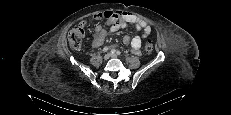 File:Breast cancer pelvic bony metastases (Radiopaedia 84470-99824 Axial bone window 19).jpg
