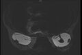 Breast implant rupture (Radiopaedia 11253-11617 A 1).jpg