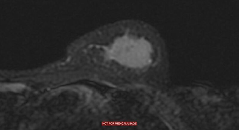 File:Breast lymphoma (MRI) (Radiopaedia 34999-36498 Axial STIR 10).jpg