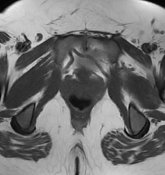 File:Broad ligament leiomyoma (Radiopaedia 81634-95516 Axial T1 24).jpg