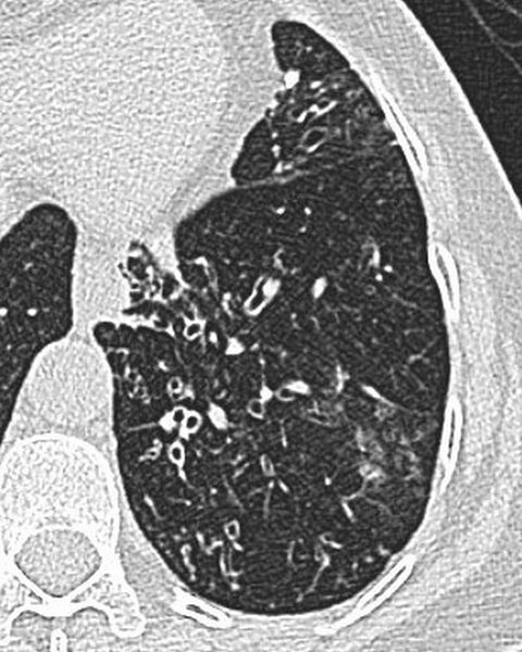 File:Bronchiectasis (Radiopaedia 2587-6282 Axial lung window 1).jpg