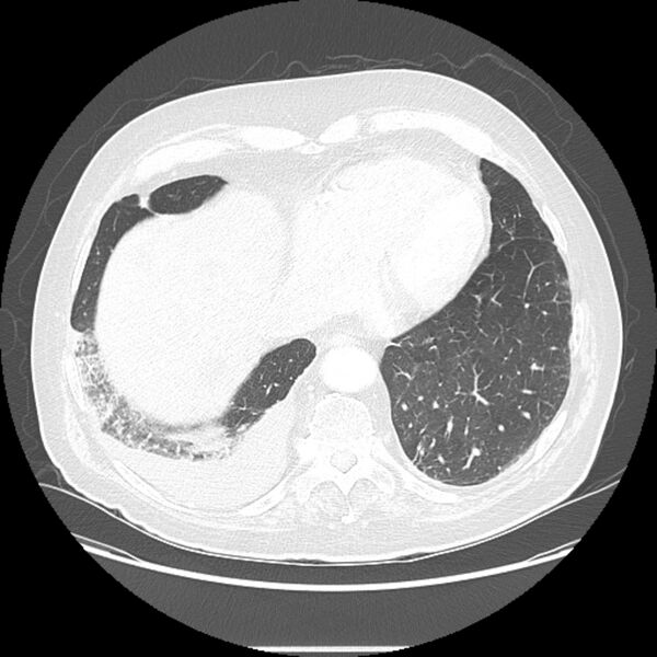File:Bronchogenic adenocarcinoma and pulmonary embolism (Radiopaedia 9097-9806 Axial lung window 23).jpg