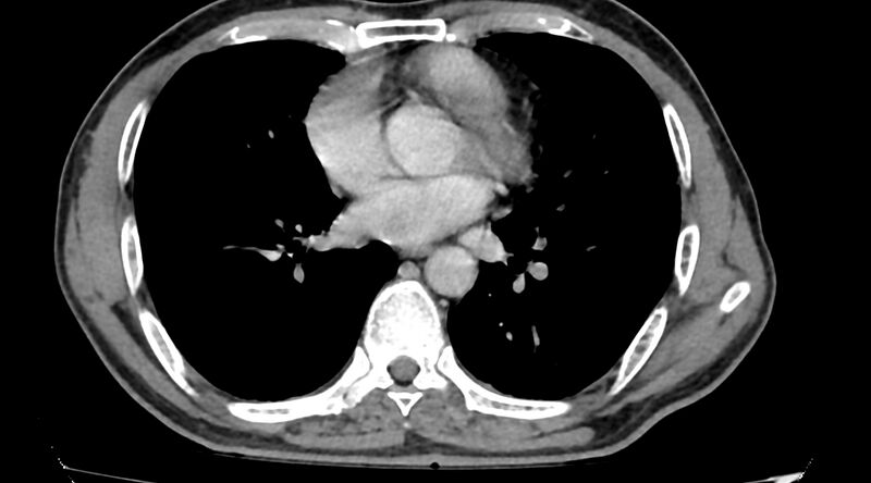 File:Bronchogenic carcinoma with superior vena cava syndrome (Radiopaedia 36497-38054 Axial C+ delayed 63).jpg