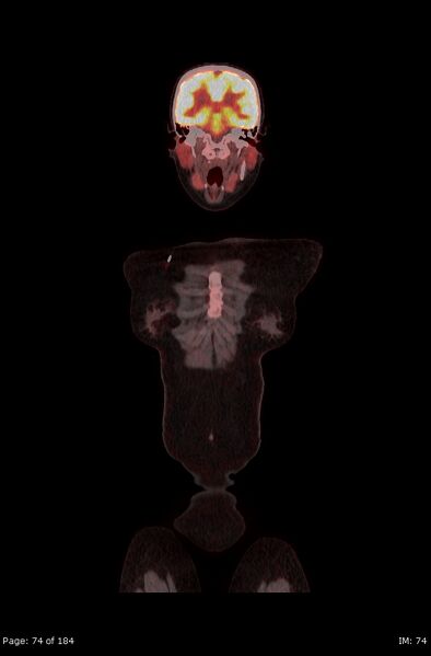 File:Brown fat uptake (FDG PET-CT) (Radiopaedia 77392-89513 Fused coronal 32).jpg