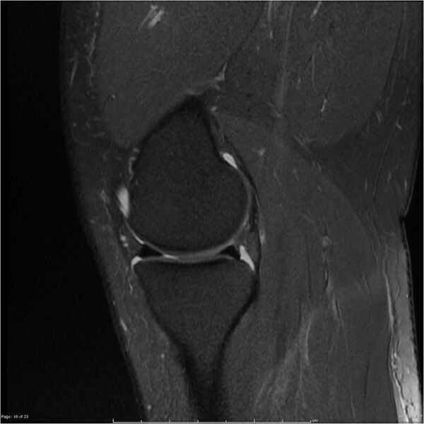 File:Bucket handle tear - lateral meniscus (Radiopaedia 7246-8187 Sagittal T2 fat sat 18).jpg
