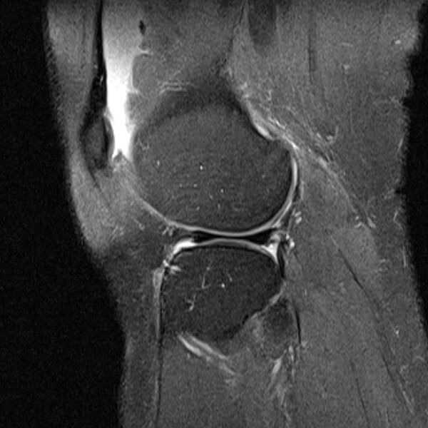 File:Bucket handle tear - medial meniscus (Radiopaedia 79028-91942 Sagittal PD fat sat 5).jpg