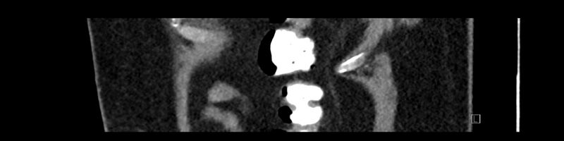 File:Buried bumper syndrome - gastrostomy tube (Radiopaedia 63843-72575 Sagittal Inject 12).jpg