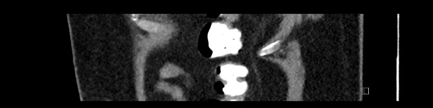 Buried bumper syndrome - gastrostomy tube (Radiopaedia 63843-72575 Sagittal Inject 12).jpg