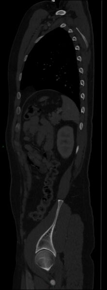 File:Burst fracture (Radiopaedia 83168-97542 Sagittal bone window 95).jpg