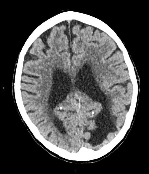File:Calcified cerebral emboli from left ventricular thrombus (Radiopaedia 84420-99758 Axial non-contrast 38).jpg