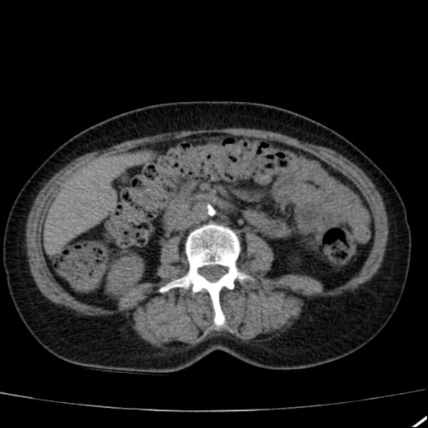 File:Calcified hepatic hydatid cyst (Radiopaedia 26872-27046 Axial non-contrast 45).jpg