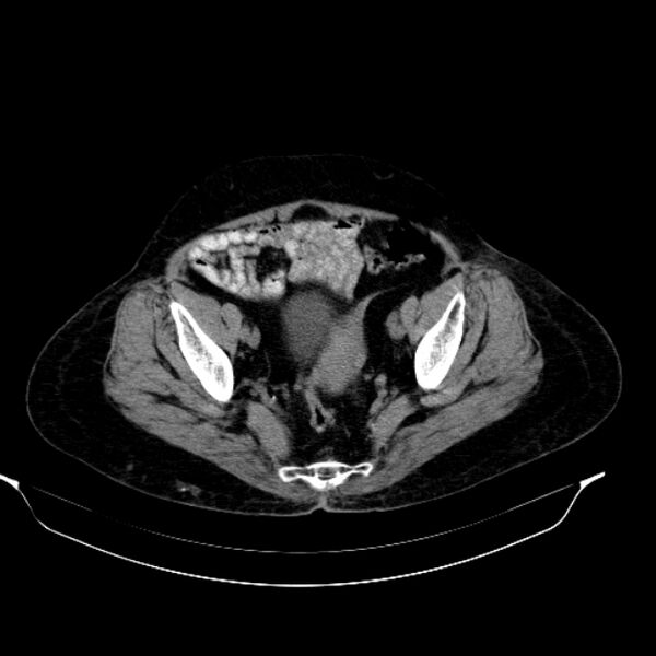 File:Calcified hydatid cyst (Radiopaedia 62000-70085 Axial non-contrast 93).jpg
