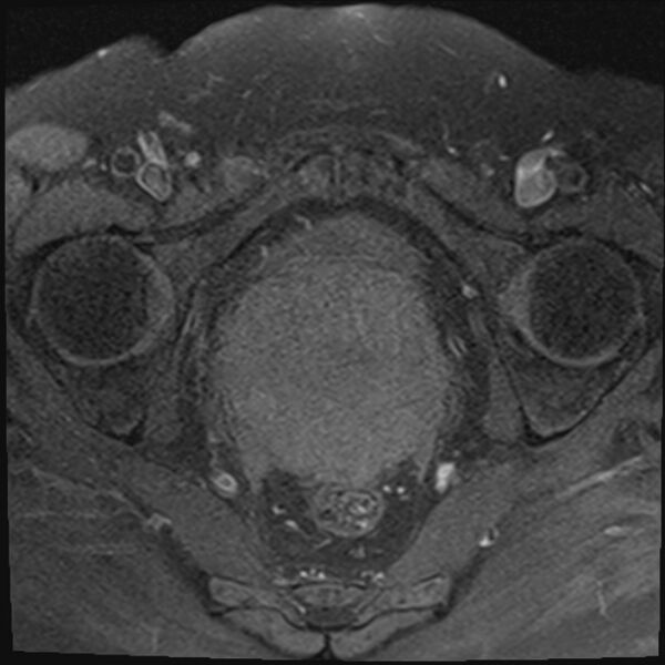 File:Cancer cervix - stage IIb (Radiopaedia 75411-86615 T1 fat sat 14).jpg