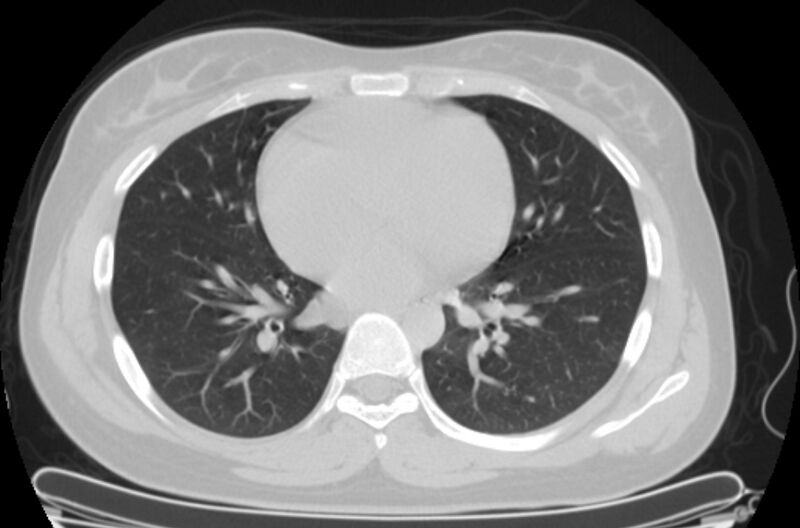 File:Cannonball metastases - uterine choriocarcinoma (Radiopaedia 70137-80173 Axial lung window 63).jpg