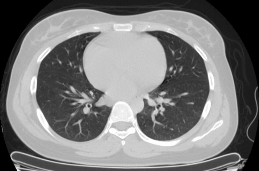 Cannonball metastases - uterine choriocarcinoma (Radiopaedia 70137-80173 Axial lung window 63).jpg