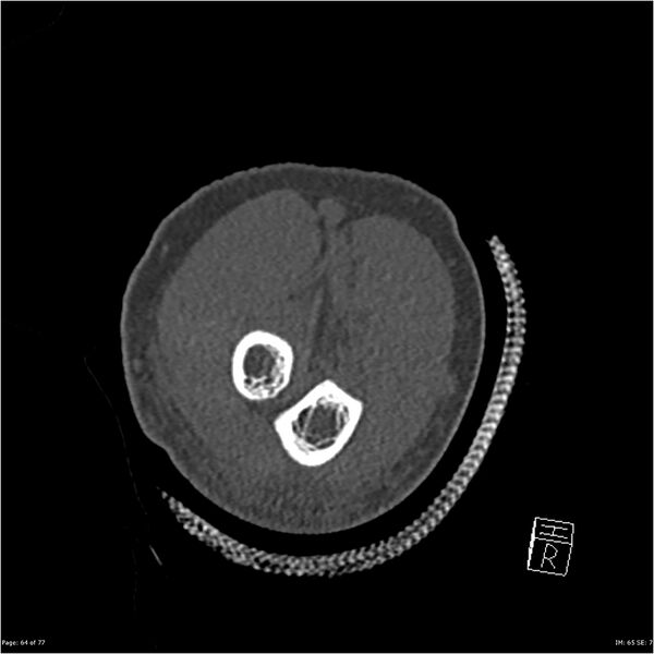 File:Capitellum fracture (Radiopaedia 23352-23426 Coronal bone window 64).jpg