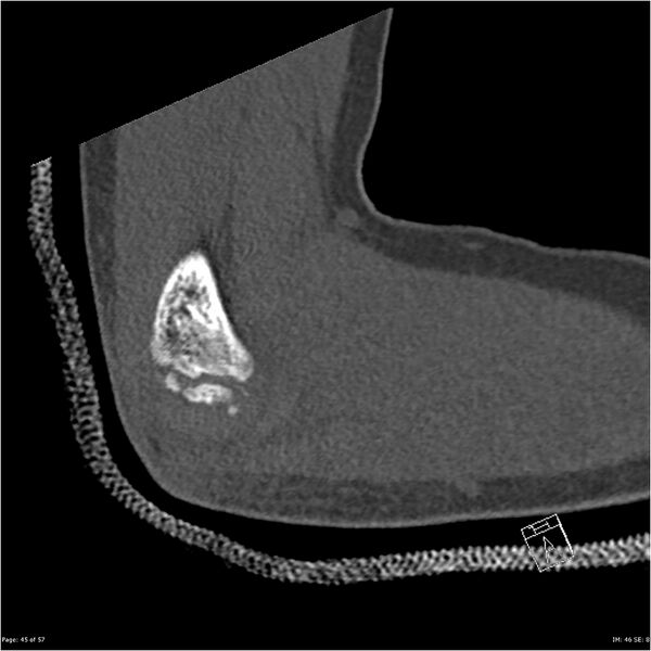 File:Capitellum fracture (Radiopaedia 23352-23426 Sagittal bone window 45).jpg