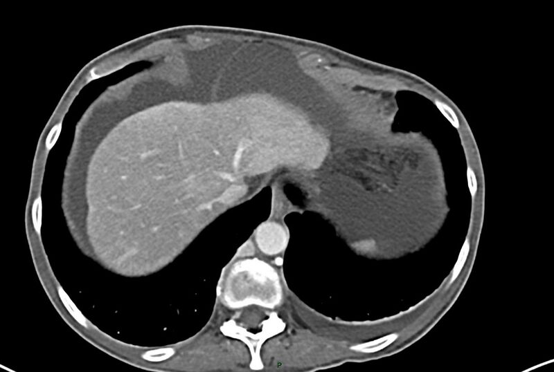File:Carcinoid mesenteric tumor complicated by chylous ascites (Radiopaedia 76312-87953 A 7).jpg