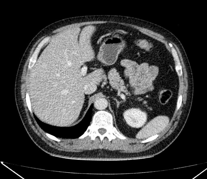 File:Carcinoid tumor with hepatic metastases (Radiopaedia 22651-22670 C 37).jpg