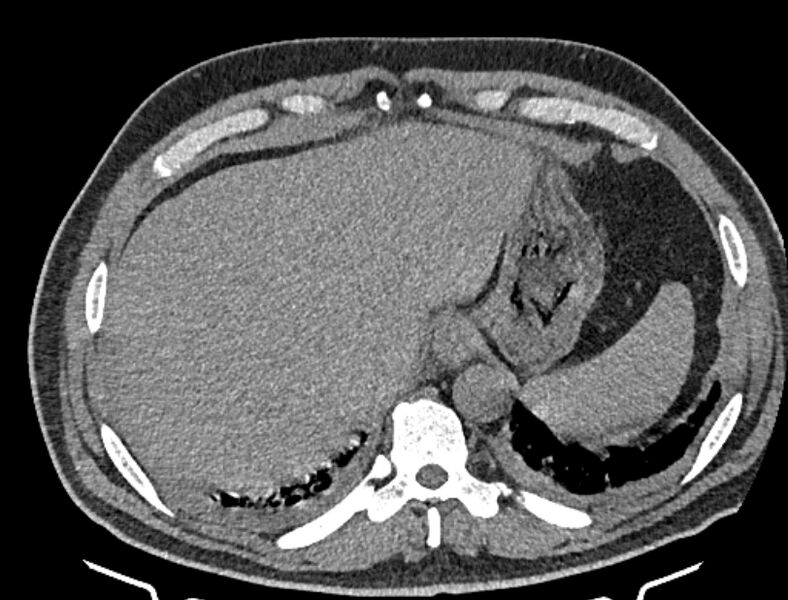 File:Cardiogenic pulmonary edema (Radiopaedia 68180-77678 Axial non-contrast 48).jpg