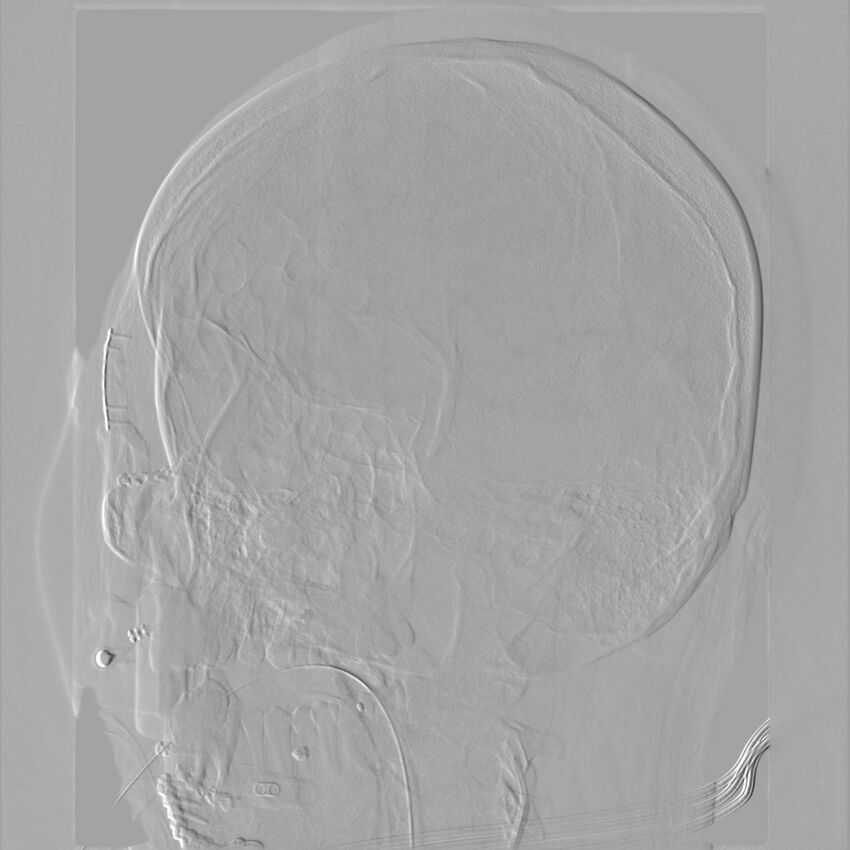 Caroticocavernous fistula - direct (Radiopaedia 61660-69666 Oblique Left ICA 46).jpg