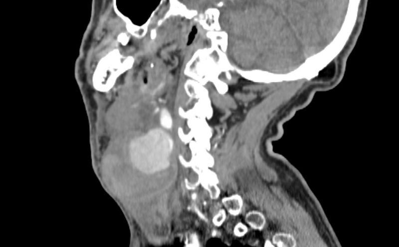 File:Carotid artery pseudoaneurysm (Radiopaedia 84030-99259 E 25).jpg
