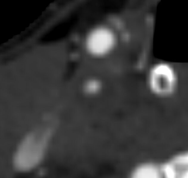 File:Carotid near-occlusion (Radiopaedia 85304-100887 M 47).jpg
