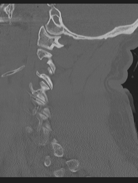 File:Cavernoma of cervical cord (Radiopaedia 50838-56346 Sagittal bone window 26).png