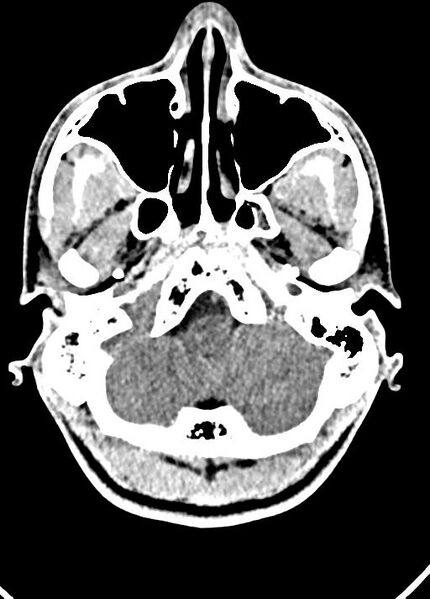 File:Cavum septum pellucidum and cavum vergae (Radiopaedia 77797-90060 Axial Brain Window 16).jpg