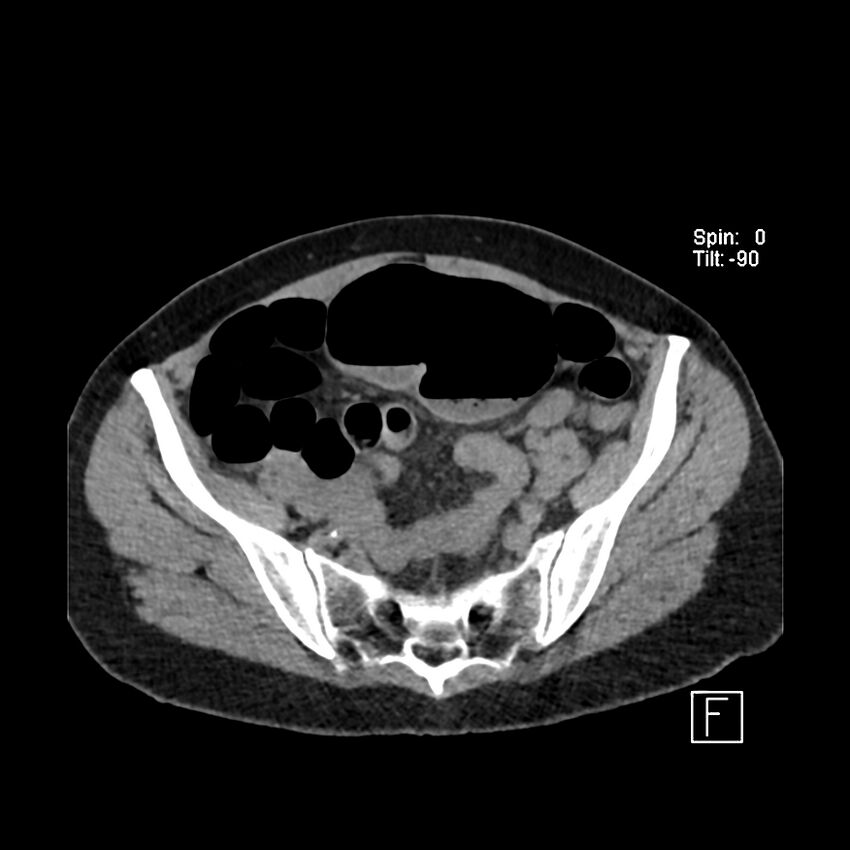 Cecal volvulus (Radiopaedia 90897-108397 Axial non-contrast 51).jpg