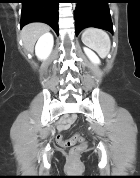 File:Cecum hernia through the foramen of Winslow (Radiopaedia 46634-51112 B 35).png