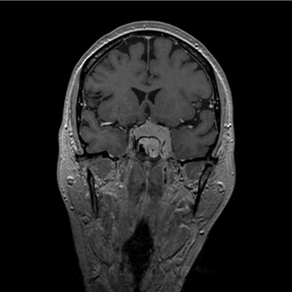 File:Central base of skull meningioma (Radiopaedia 53531-59549 Coronal T1 C+ 9).jpg