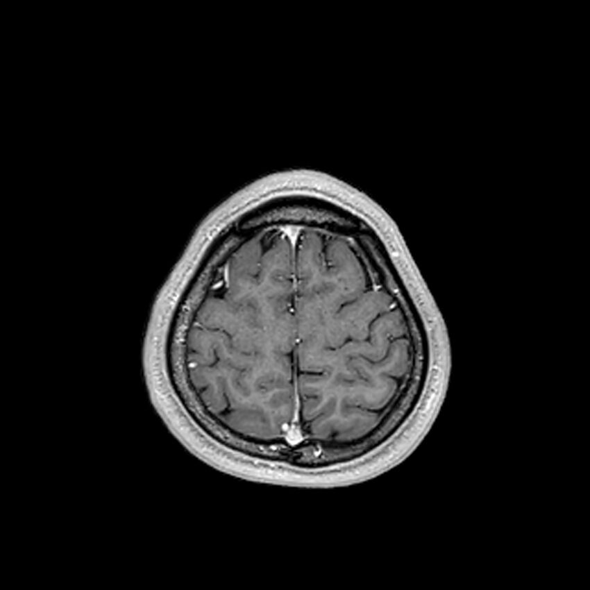 Central neurocytoma (Radiopaedia 79320-92380 Axial T1 C+ 202).jpg