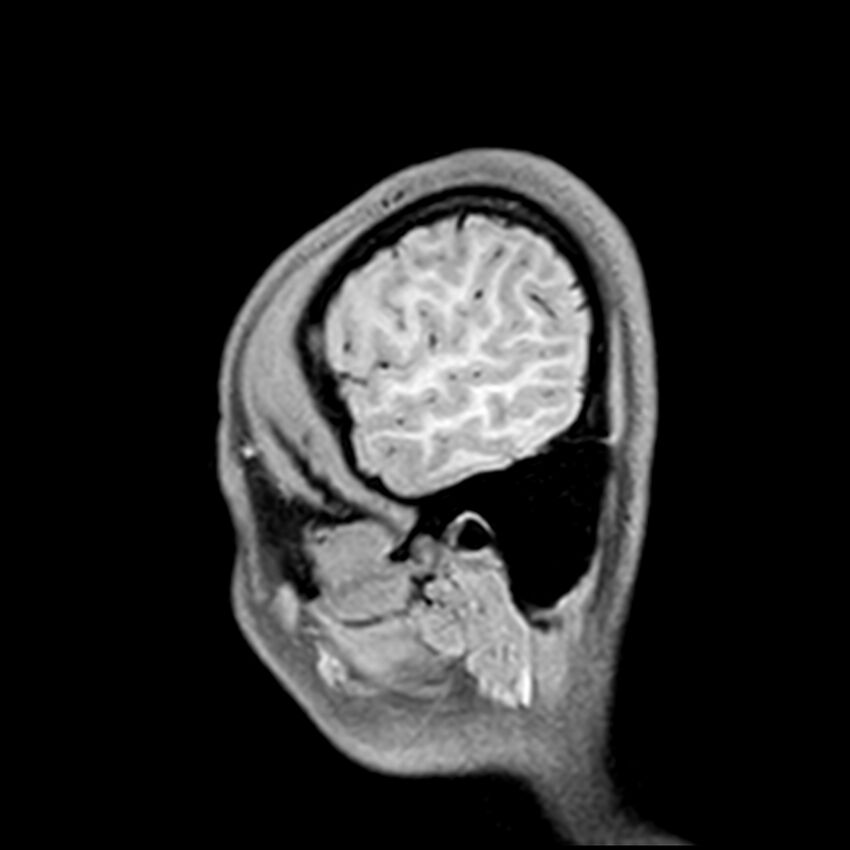 Central neurocytoma (Radiopaedia 79320-92380 Sagittal T1 229).jpg