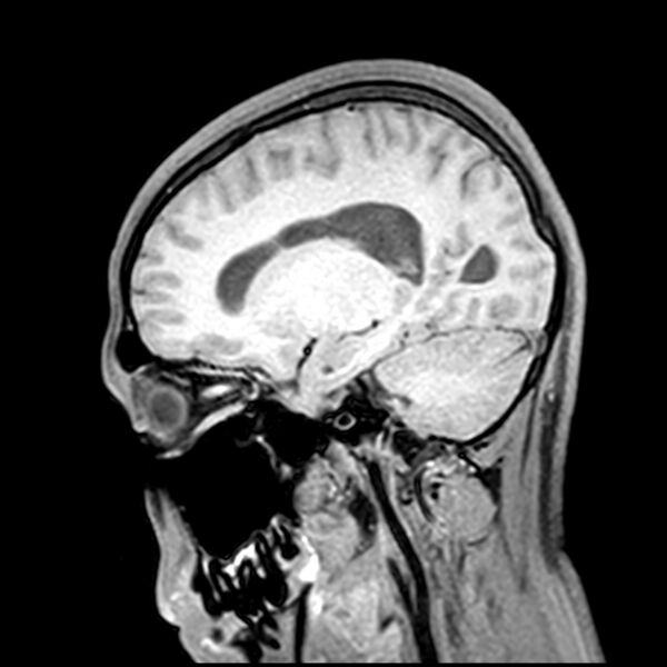 File:Central neurocytoma (Radiopaedia 79320-92380 Sagittal T1 94).jpg