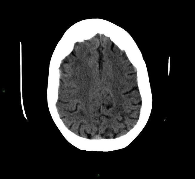 File:Cerebellar hemorrhage (Radiopaedia 58792-66026 Axial non-contrast 14).jpg