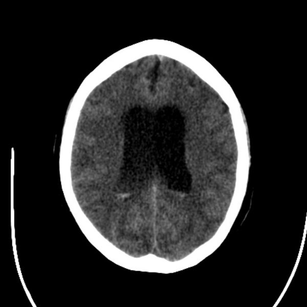 File:Cerebellar hemorrhage causing obstructive hydrocephalus (Radiopaedia 33989-35207 Axial non-contrast 33).jpg