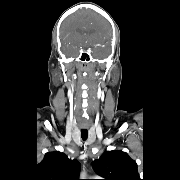 File:Cerebellar infarct due to vertebral artery dissection with posterior fossa decompression (Radiopaedia 82779-97029 D 26).png