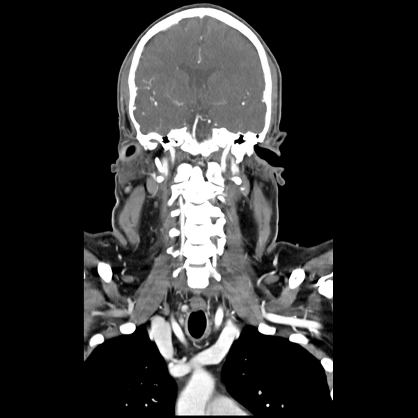 File:Cerebellar infarct due to vertebral artery dissection with posterior fossa decompression (Radiopaedia 82779-97029 D 30).png