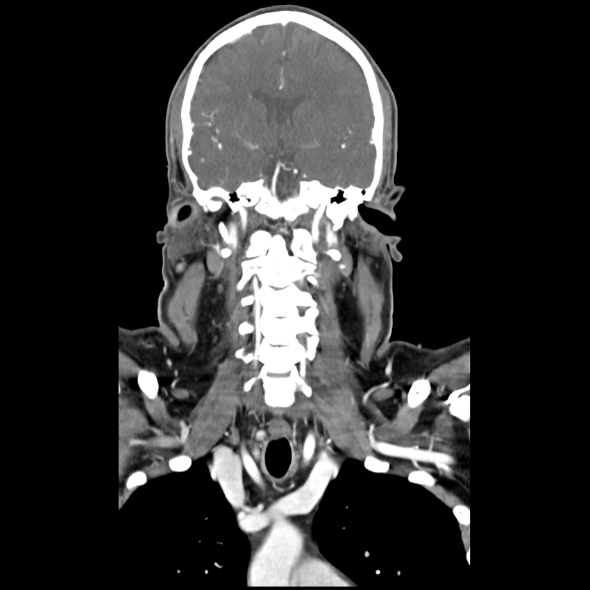 Cerebellar infarct due to vertebral artery dissection with posterior fossa decompression (Radiopaedia 82779-97029 D 30).png