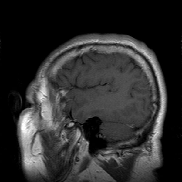 File:Cerebellopontine angle meningioma (Radiopaedia 24459-24764 Sagittal T1 C+ 22).jpg
