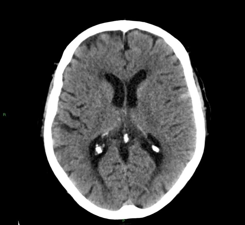 Cerebral amyloid angiopathy-associated lobar intracerebral hemorrhage (Radiopaedia 58376-65511 Axial non-contrast 29).jpg