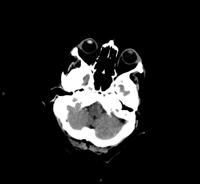 File:Cerebral amyloid angiopathy-associated lobar intracerebral hemorrhage (Radiopaedia 58377-65514 Axial non-contrast 40).jpg