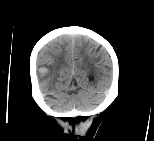 File:Cerebral amyloid angiopathy-associated lobar intracerebral hemorrhage (Radiopaedia 58378-65516 Coronal non-contrast 17).jpg