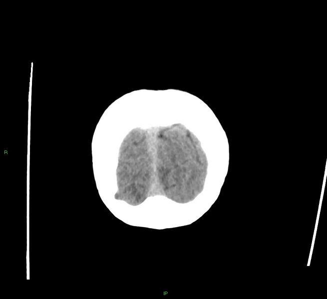 File:Cerebral amyloid angiopathy-associated lobar intracerebral hemorrhage (Radiopaedia 58378-65516 Coronal non-contrast 7).jpg