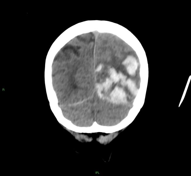 File:Cerebral amyloid angiopathy-associated lobar intracerebral hemorrhage (Radiopaedia 58754-65975 Coronal non-contrast 15).jpg