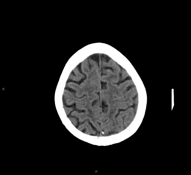 File:Cerebral amyloid angiopathy-associated lobar intracerebral hemorrhage (Radiopaedia 58757-65978 Axial non-contrast 13).jpg